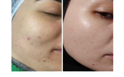 What Is an Algae Peel? A Professional Guide for UAE Skin Renewal