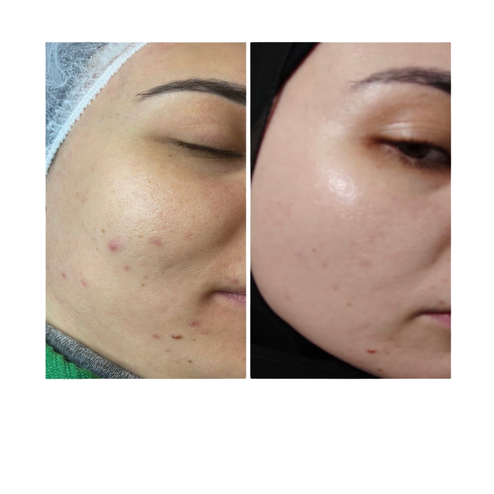 Professional algae peel compared with herbal and chemical peeling treatments